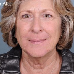 Dermabrasion Before & After Patient #1404