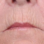 Non-Surgical Before & After Patient #1403