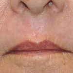 Non-Surgical Before & After Patient #1403