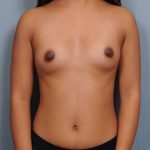 Breast Augmentation Before & After Patient #673