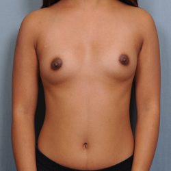Breast Augmentation Before & After Patient #673