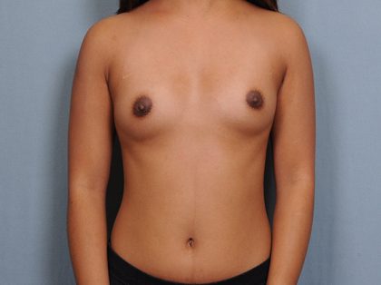 Breast Augmentation Before & After Patient #673