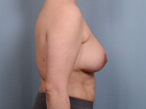 Breast Augmentation Before & After Patient #678