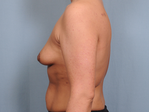 Breast Augmentation Before & After Patient #678