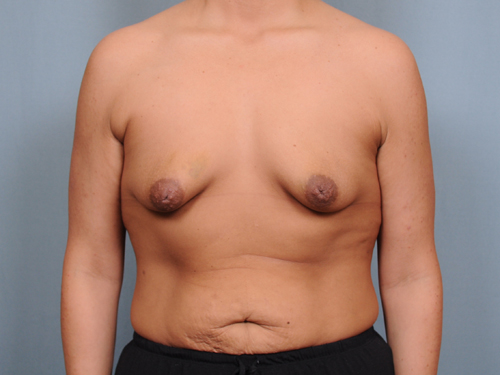 Breast Augmentation Before & After Patient #678