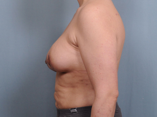 Breast Augmentation Before & After Patient #678