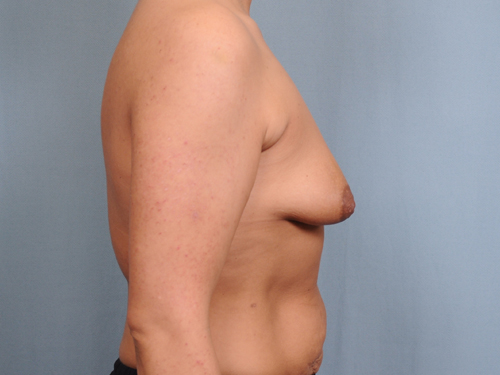 Breast Augmentation Before & After Patient #678