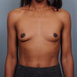 Breast Augmentation Before & After Patient #782