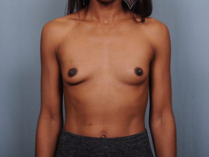 Breast Augmentation Before & After Patient #782