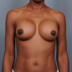 Breast Augmentation Before & After Patient #782