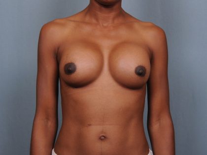 Breast Augmentation Before & After Patient #782
