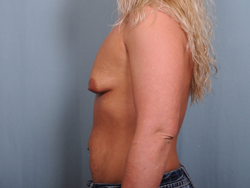 Breast Augmentation Before & After Patient #907