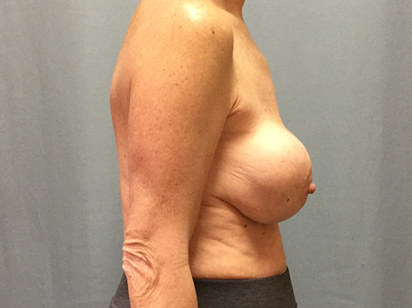 Breast Augmentation Before & After Patient #1285