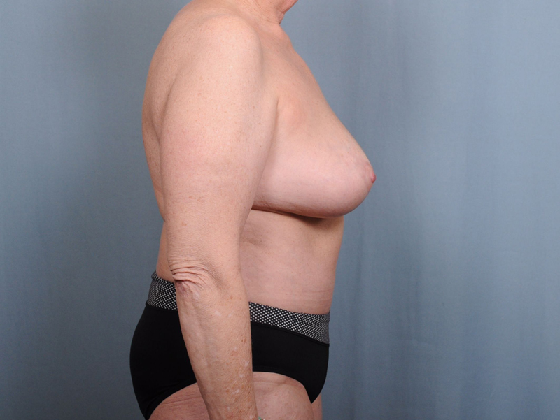 Abdominoplasty Before & After Patient #1219