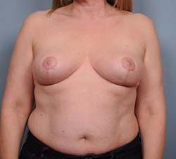 Breast Reduction Before & After Patient #1921