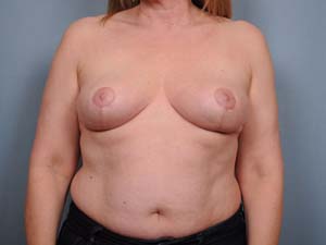 Breast Reduction Before & After Patient #1921