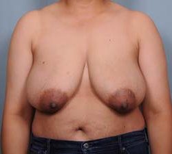 Breast Reduction Before & After Patient #1920
