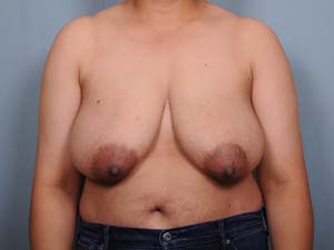 Breast Reduction Before & After Patient #1920