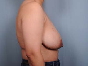 Breast Reduction Before & After Patient #1920