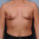 Breast Augmentation Before & After Patient #1919