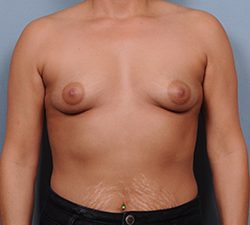 Breast Augmentation Before & After Patient #1919