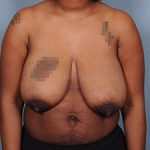 Breast Reduction Before & After Patient #1914