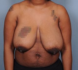 Breast Reduction Before & After Patient #1914