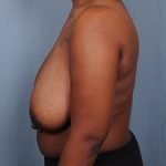 Breast Reduction Before & After Patient #1914