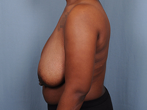 Breast Reduction Before & After Patient #1914