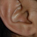 Earlobe Repair Before & After Patient #500