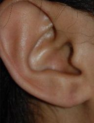 Earlobe Repair Before & After Patient #500