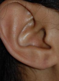 Earlobe Repair Before & After Patient #500