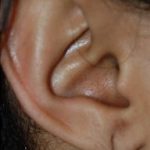 Earlobe Repair Before & After Patient #500
