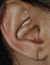 Earlobe Repair Before & After Patient #500