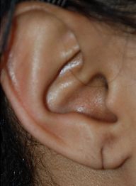 Earlobe Repair Before & After Patient #500