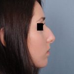 Rhinoplasty Before & After Patient #499