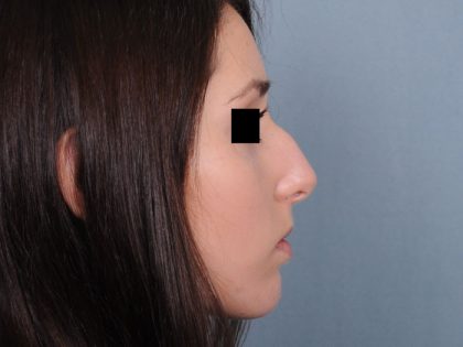Rhinoplasty Before & After Patient #499