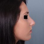 Rhinoplasty Before & After Patient #499
