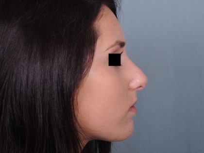 Rhinoplasty Before & After Patient #499