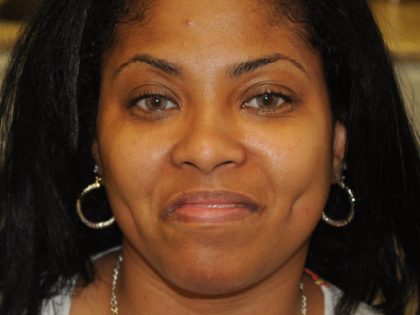 Dimple Creation Before & After Patient #494