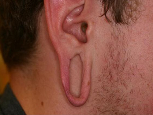 Earlobe Repair Before & After Patient #497
