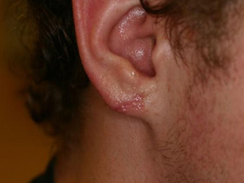 Earlobe Repair Before & After Patient #497