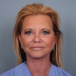 Facelift Before & After Patient #484