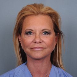 Facelift Before & After Patient #484