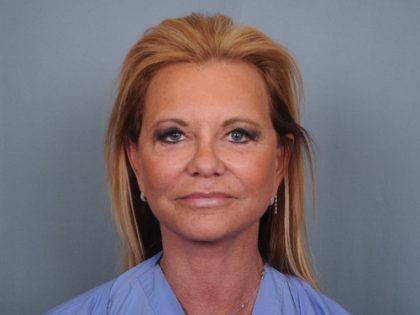 Facelift Before & After Patient #484
