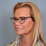 Facelift Before & After Patient #484