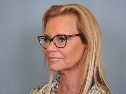 Facelift Before & After Patient #484