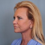 Facelift Before & After Patient #484