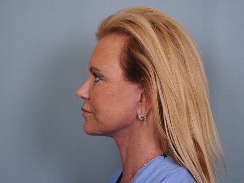 Facelift Before & After Patient #484