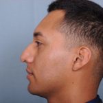 Rhinoplasty Before & After Patient #1124